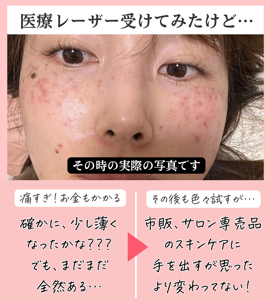 医療レーザーを受けた時の写真