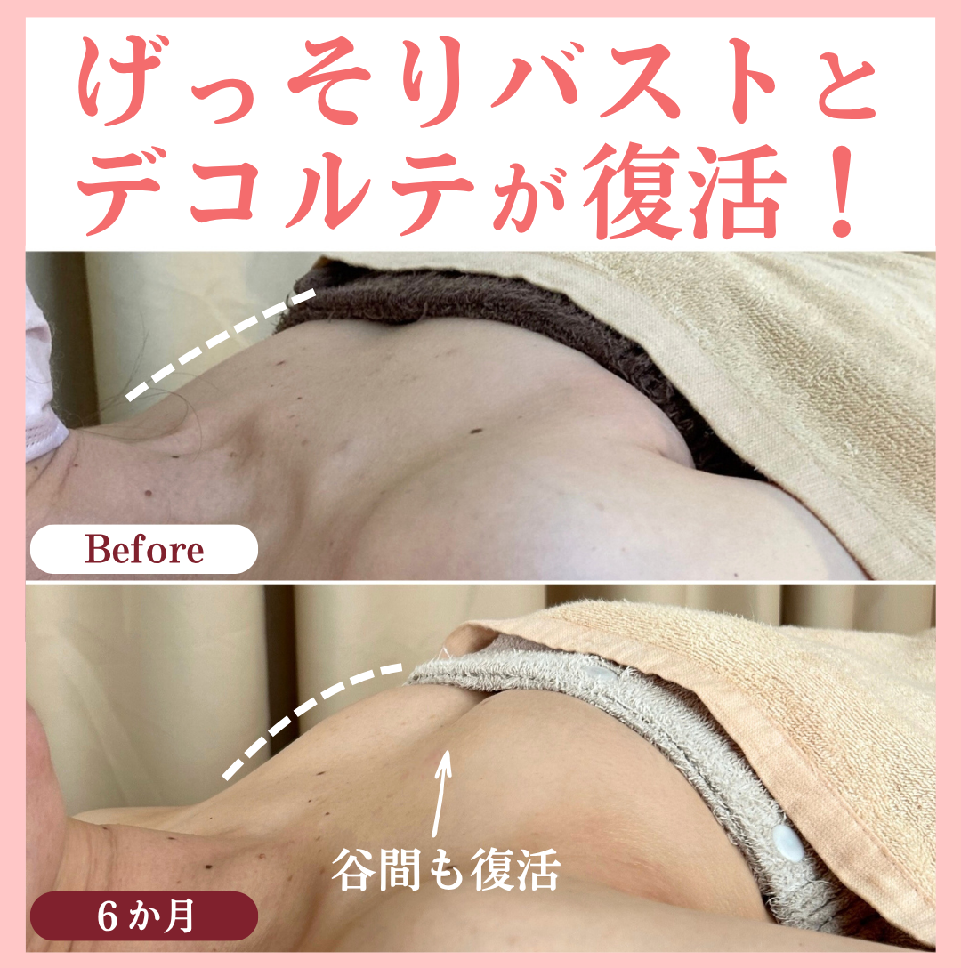 デコルテラインのビフォーアフター写真