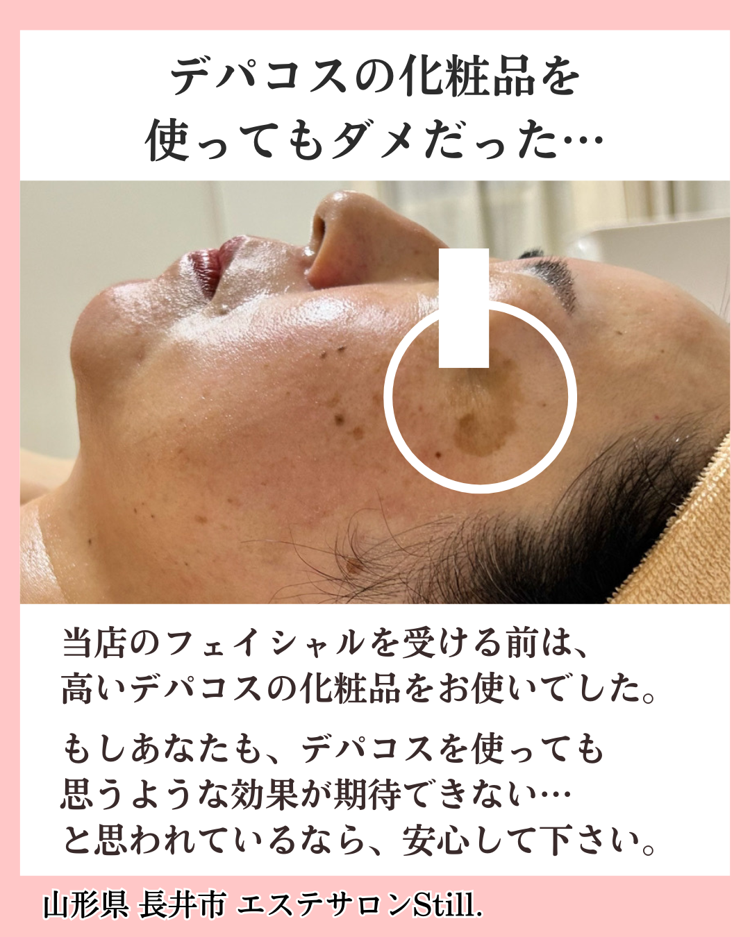 濃いシミのビフォーアフター画像２枚目