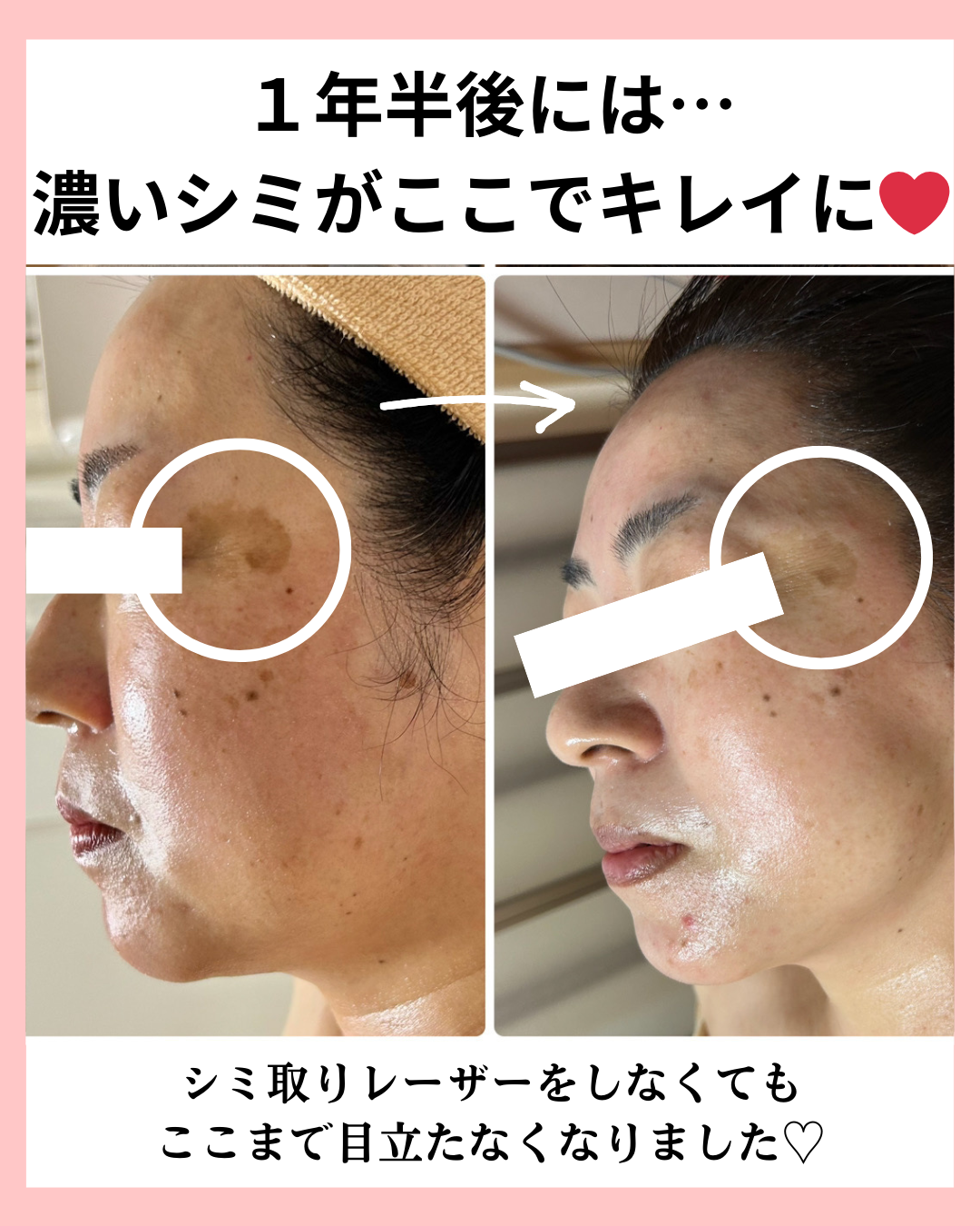 濃いシミのビフォーアフター画像３枚目