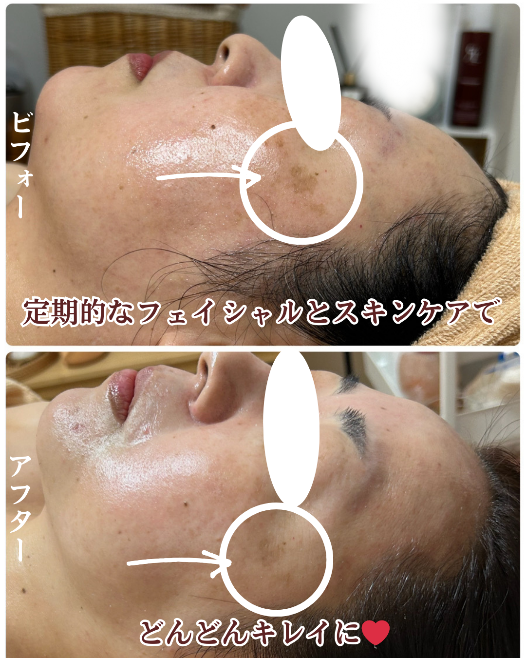 濃いシミのビフォーアフター画像４枚目