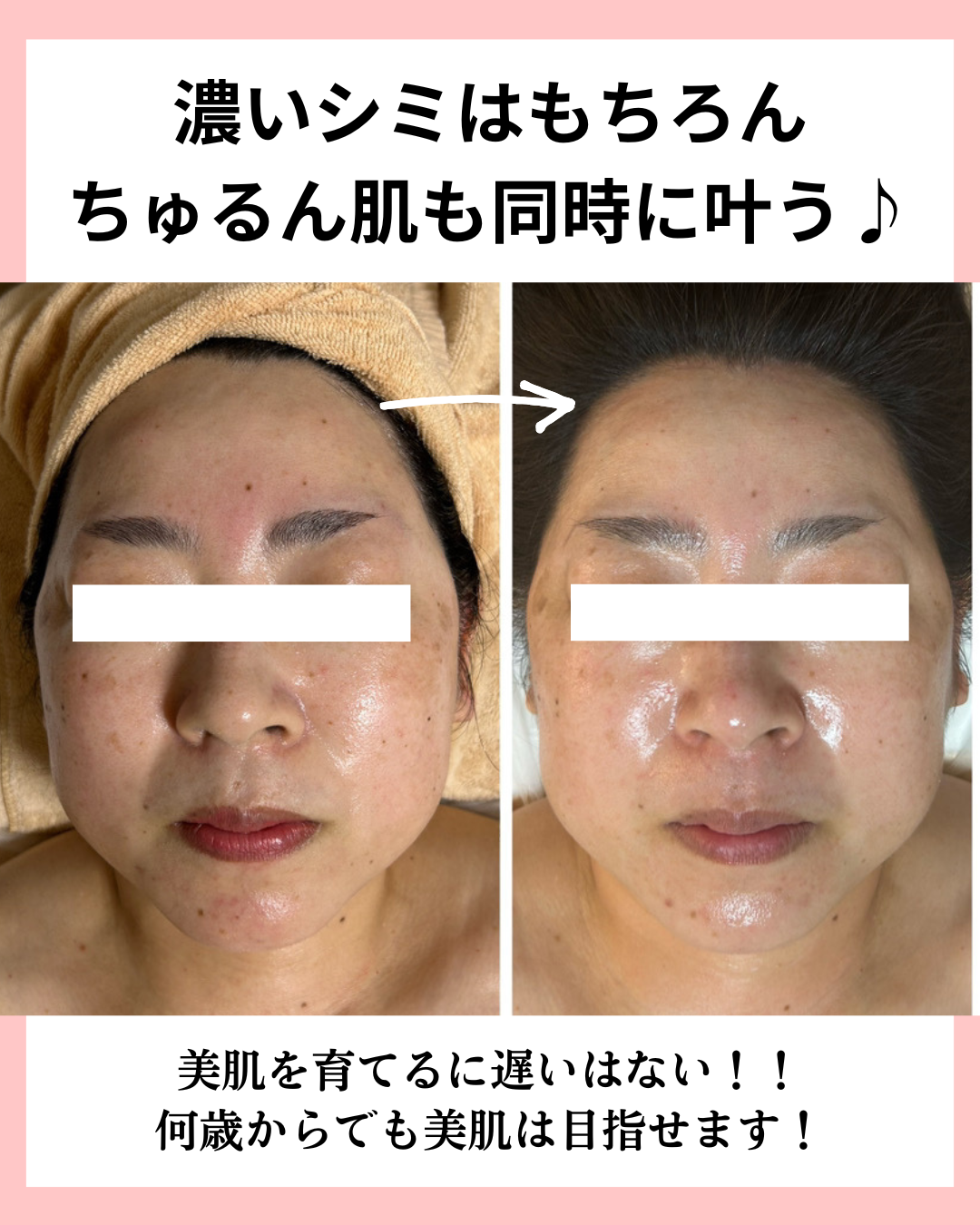 濃いシミのビフォーアフター画像５枚目