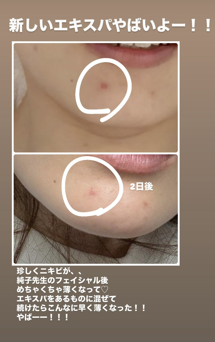ニキビ・吹き出物が改善した画像