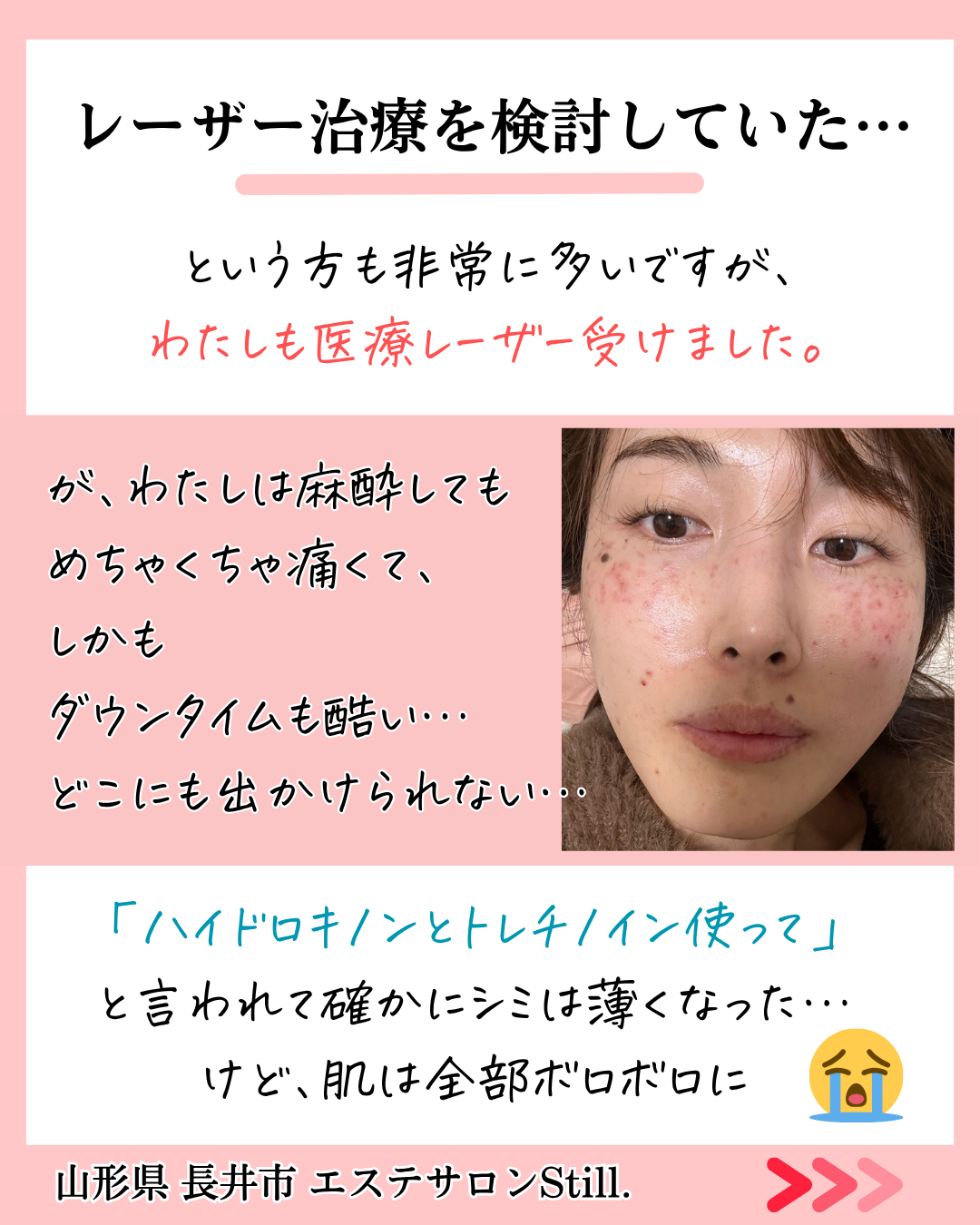 医療レーザーで失敗した時の写真