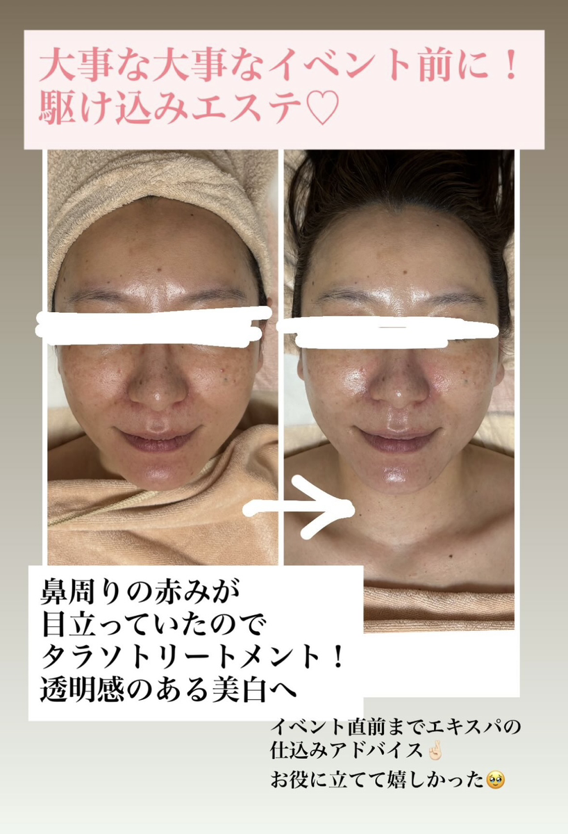 お鼻周りの赤身のビフォーアフター画像