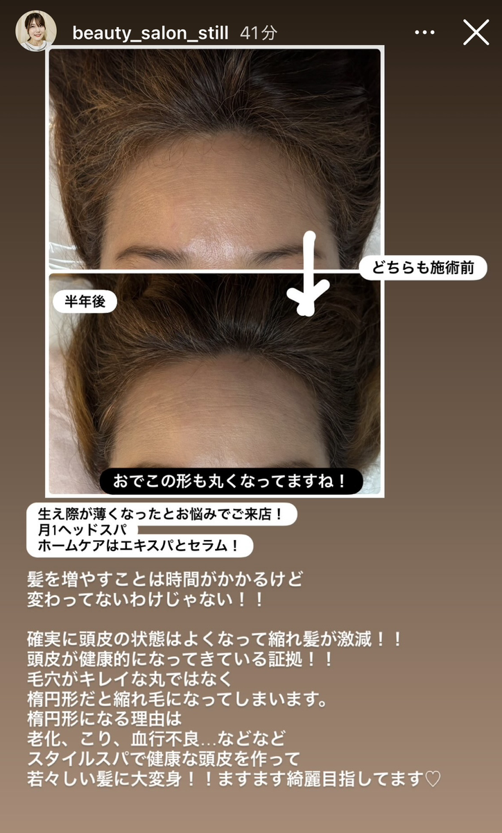 生え際が薄くなったと悩むお客様のビフォーアフター画像