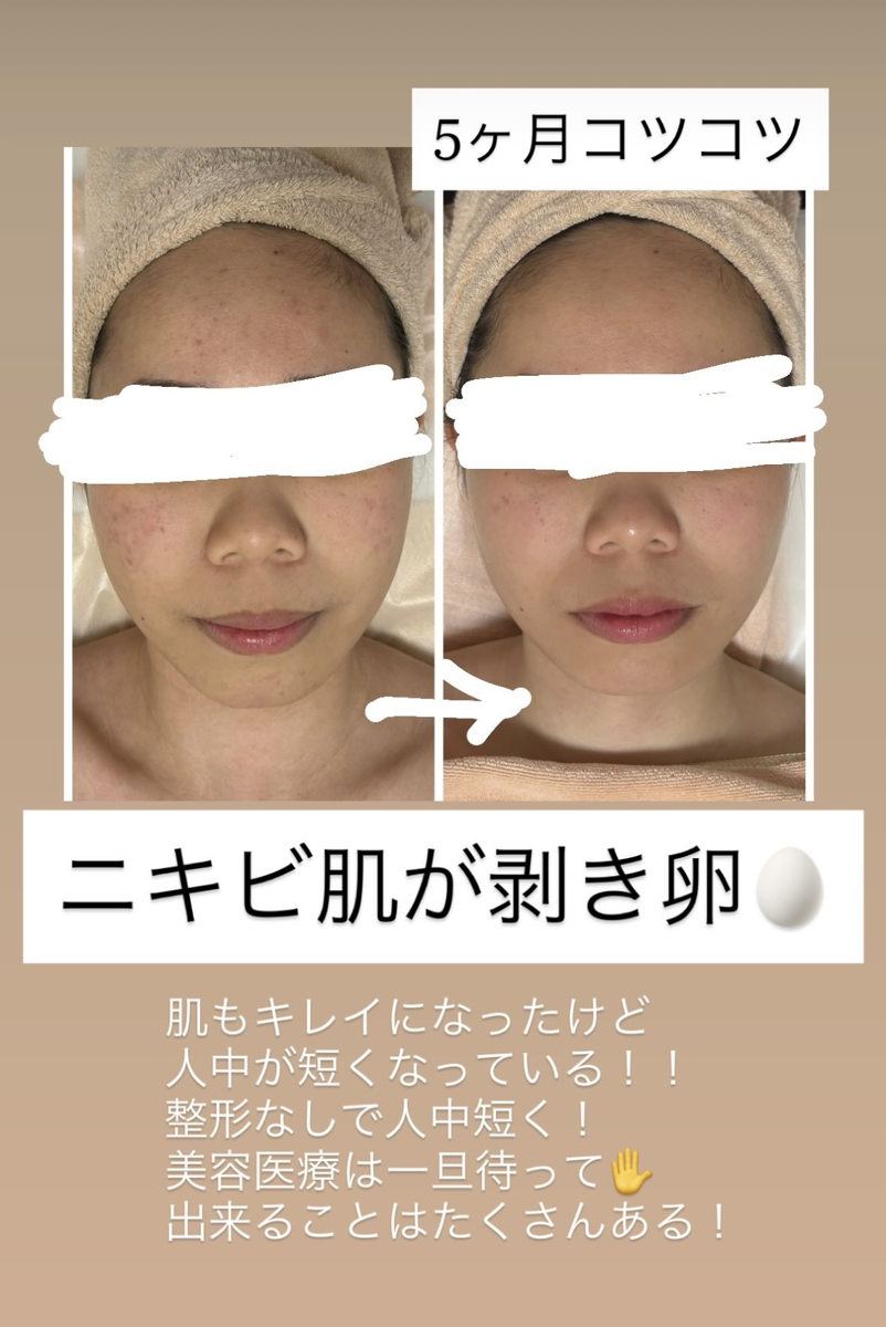ニキビ肌のビフォーアフター画像