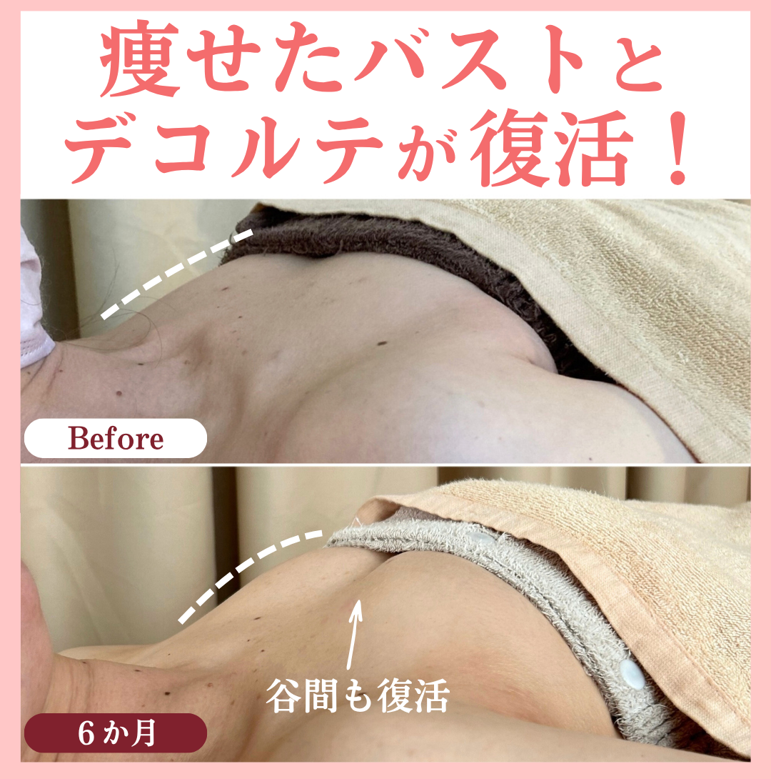 デコルテ美人のビフォーアフター画像