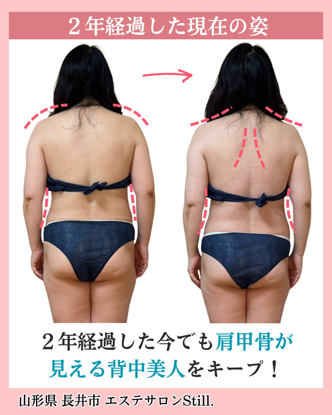 お客様のビフォーアフター背中の写真