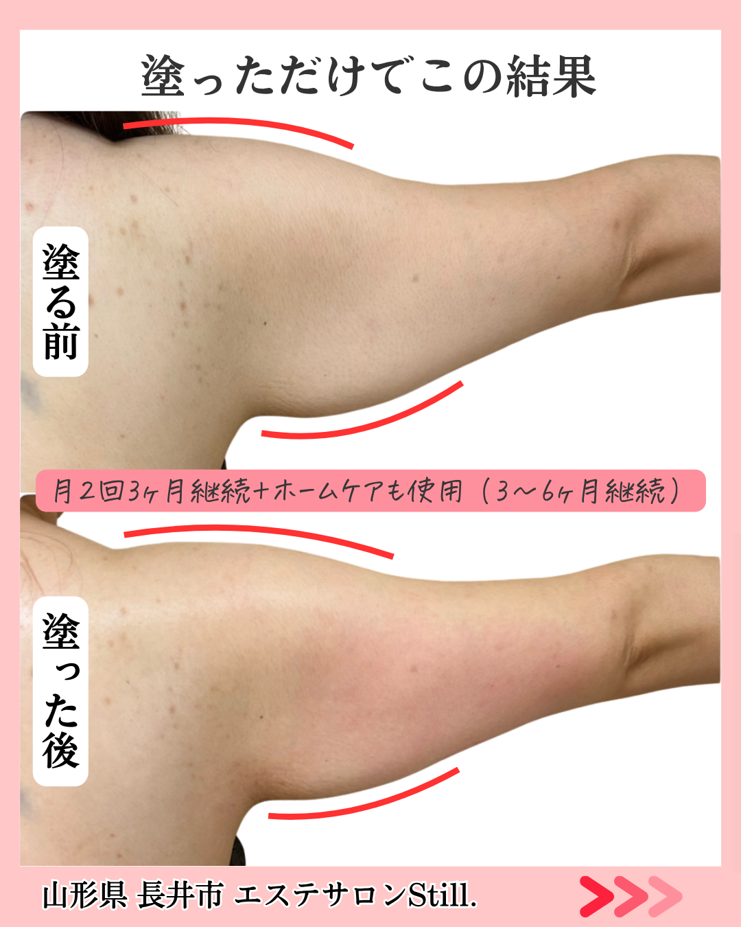 二の腕のたるみのビフォーアフター