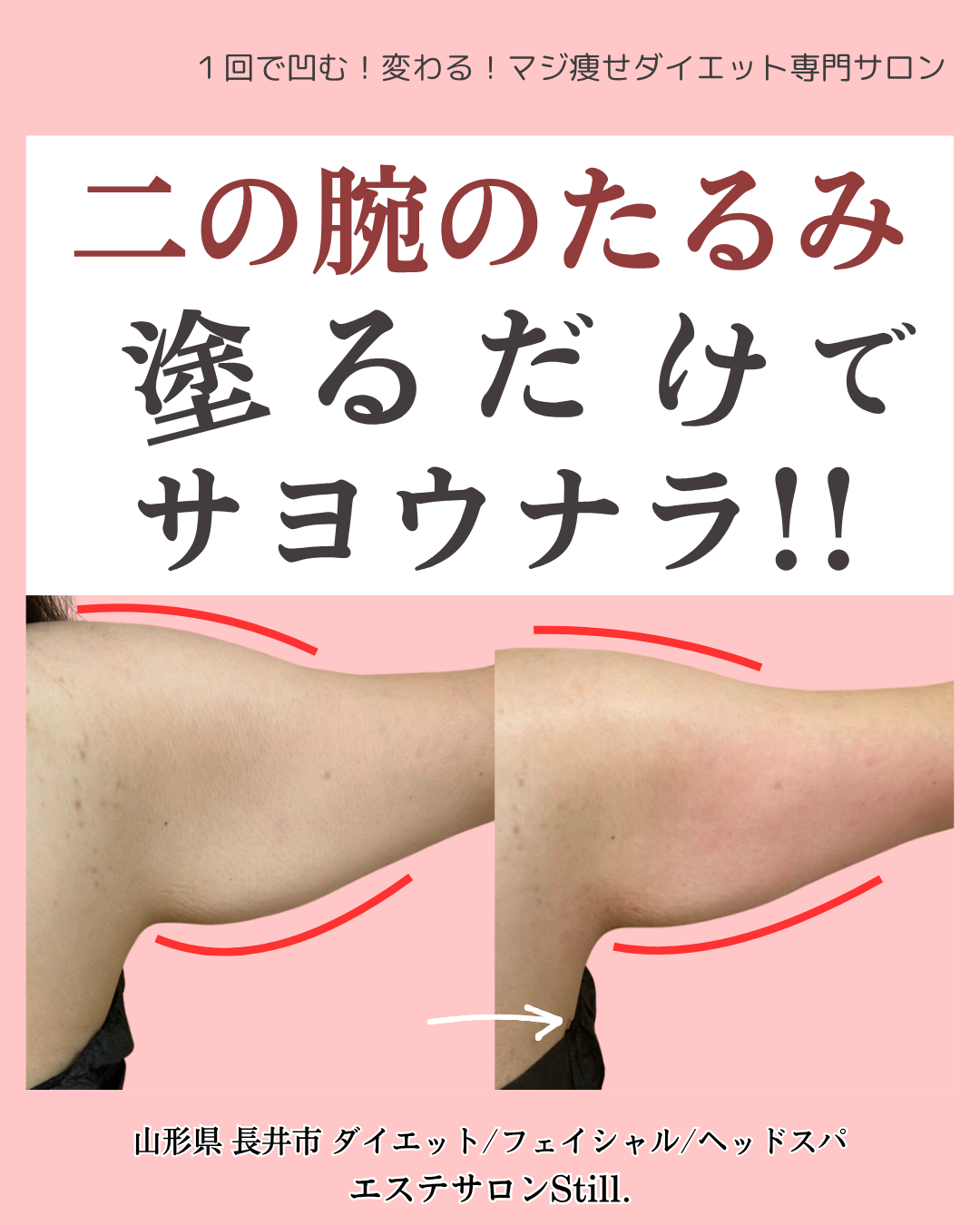 二の腕のたるみビフォーアフター画像