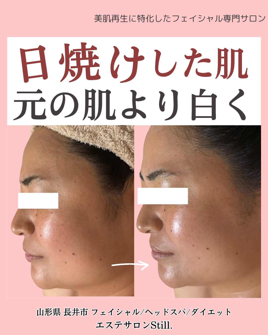 日焼けした肌のビフォーアフター右向きの画像