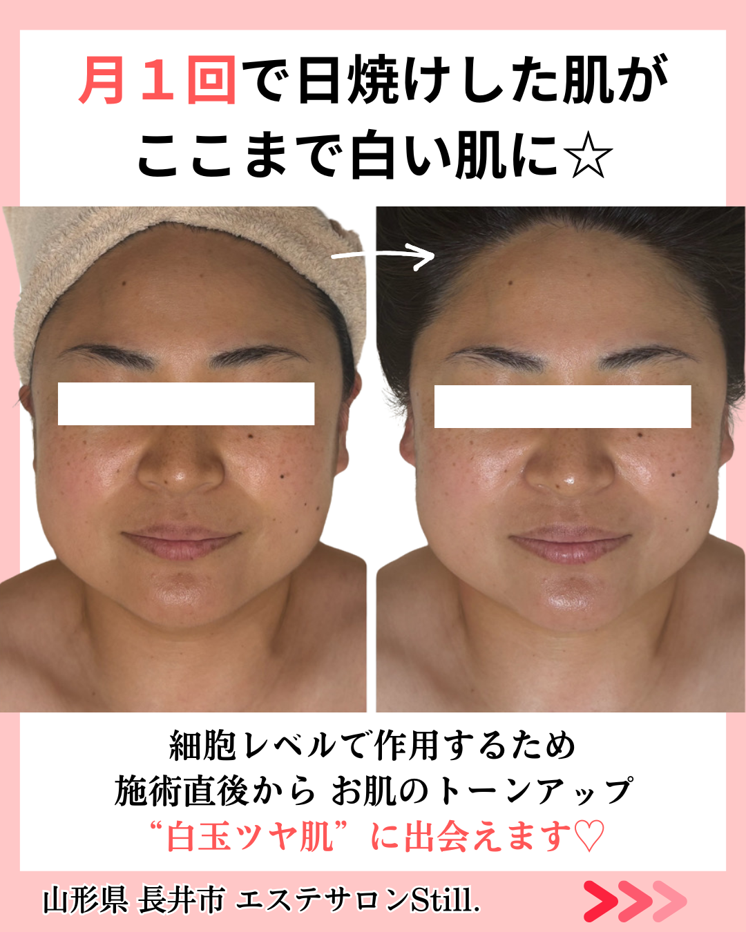 日焼けした肌のビフォーアフター真正面の画像