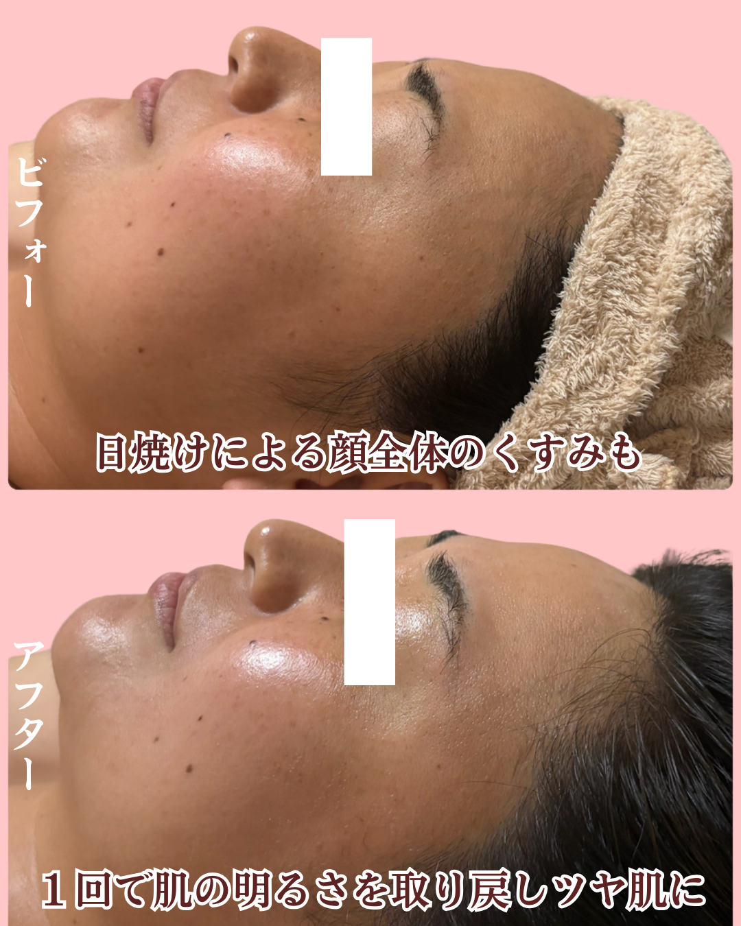 日焼けした肌のビフォーアフター真横の画像