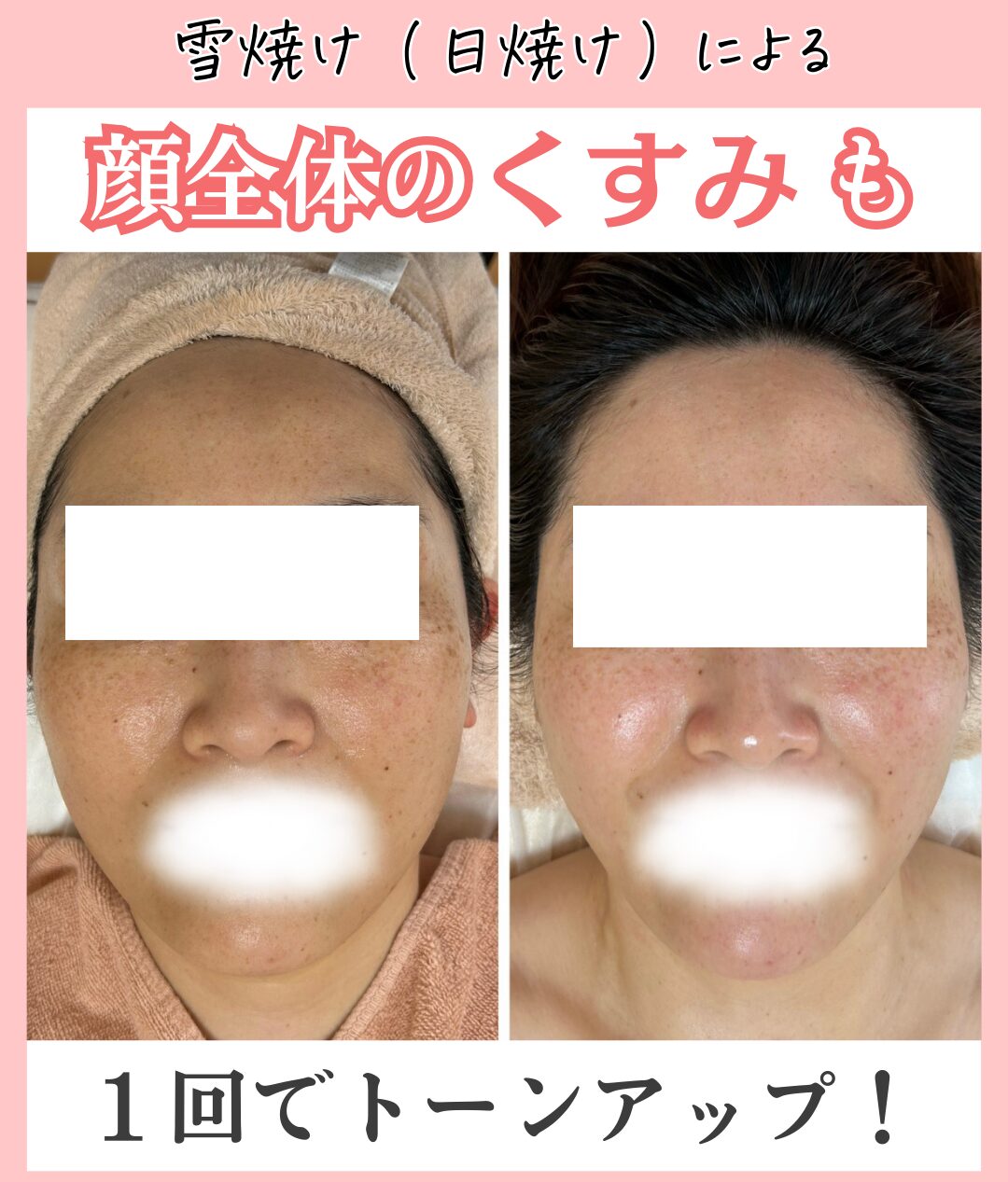 日焼け・雪焼けのビフォーアフター真正面