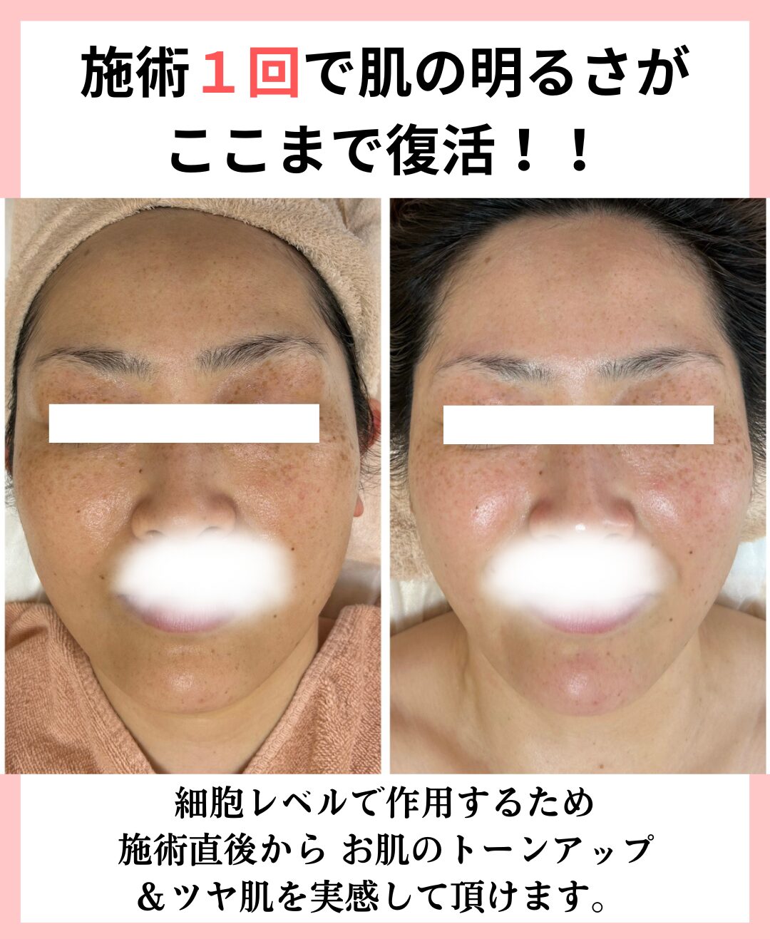 日焼け・雪焼けのビフォーアフター真正面２枚目