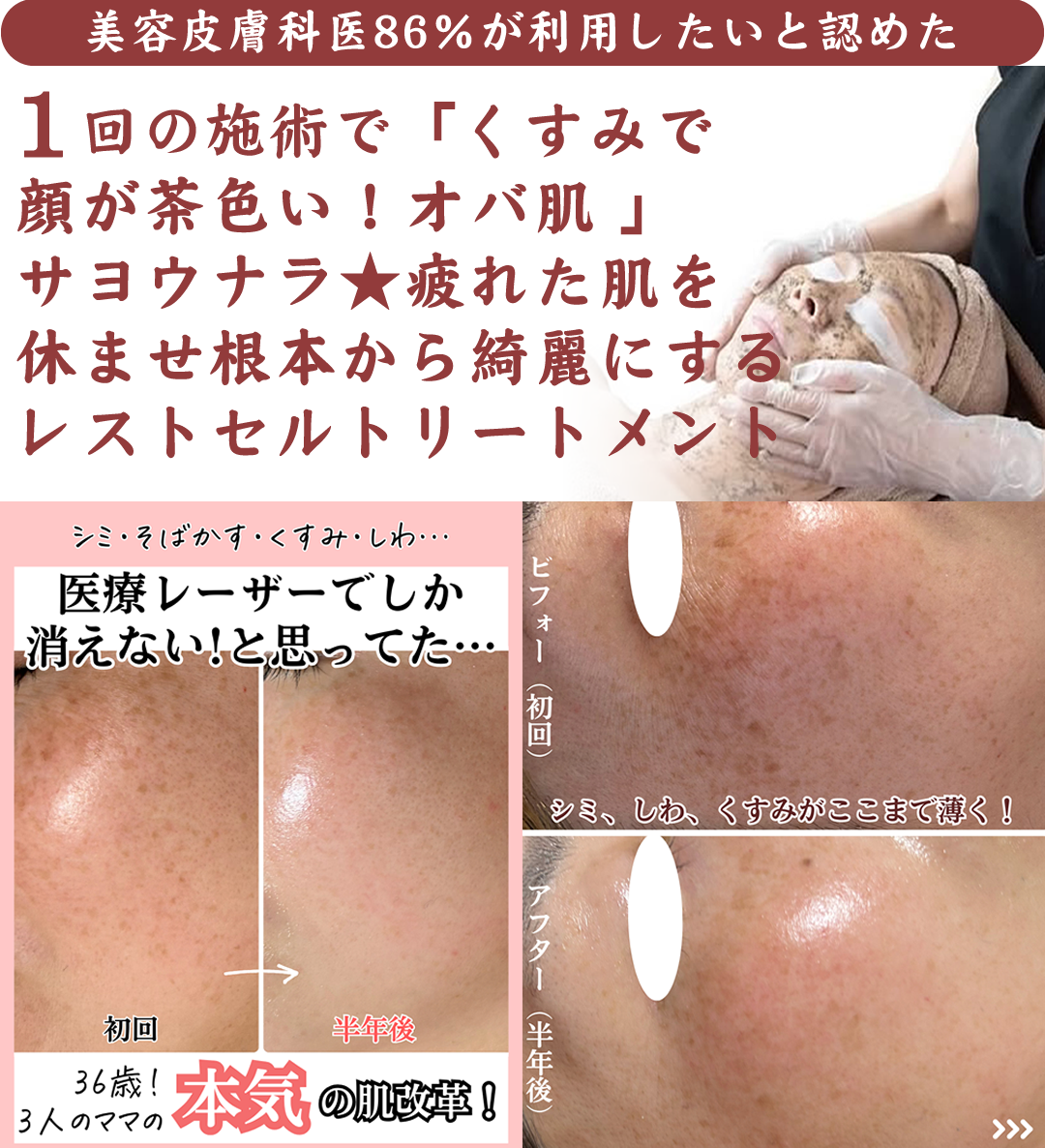 【美容皮膚科医86％が利用したいと認めた】１回の施術で「くすみで顔が茶色い！オバ肌 」サヨウナラ★疲れた肌を休ませ根本から綺麗にするレストセルトリートメント