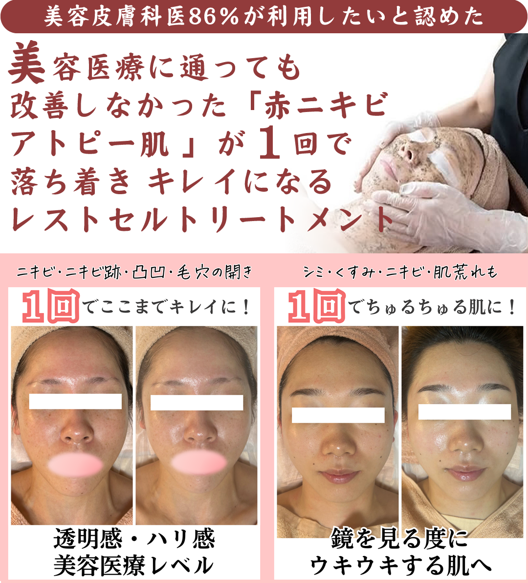 【美容皮膚科医86％が利用したいと認めた】美容医療に通っても改善しなかった「赤ニキビ・アトピー肌」を根本から綺麗にして強くするレストセルトリートメント