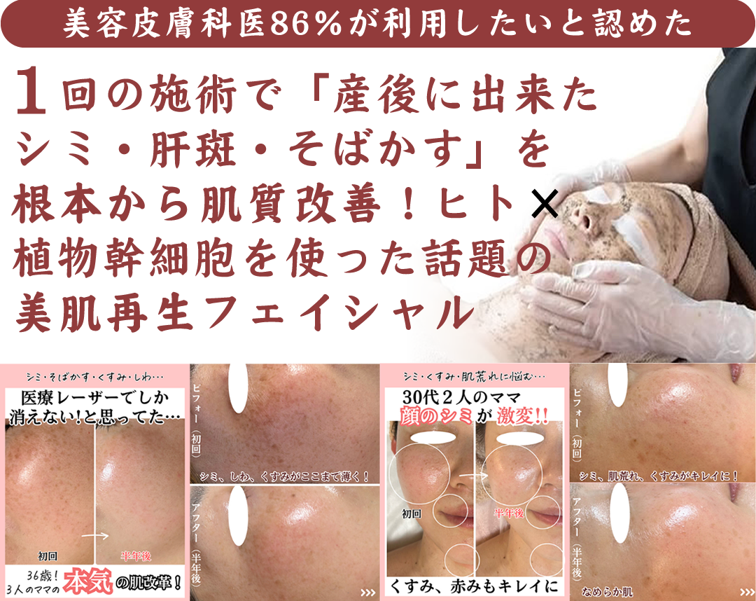 【美容皮膚科医86％が利用したいと認めた】10人中10人が一回で整形級の変化を実感！産後に出来たシミ・肝斑・そばかすを、、ヒト×植物幹細胞を使った話題の美肌再生フェイシャル