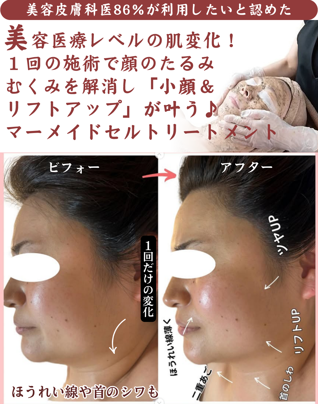【美容皮膚科医86％が利用したいと認めた】顔のたるみや むくみも１回の施術で「小顔＆リフトアップ」が叶う！マーメイドセルリートメント