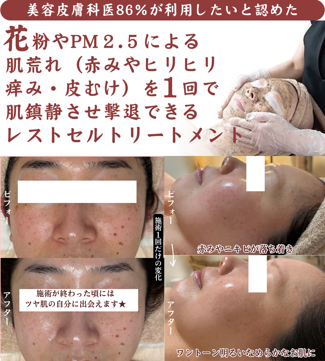 花粉に粉やPM２.５による肌荒れ（赤みやヒリヒリ痒み・皮むけ）を１回で肌鎮静させ撃退できる、レストセルトリートメント