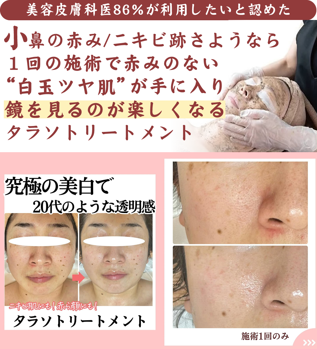 【赤ら顔】ニキビ跡・小鼻の赤みを解消！リアボーテ・タラソトリートメント