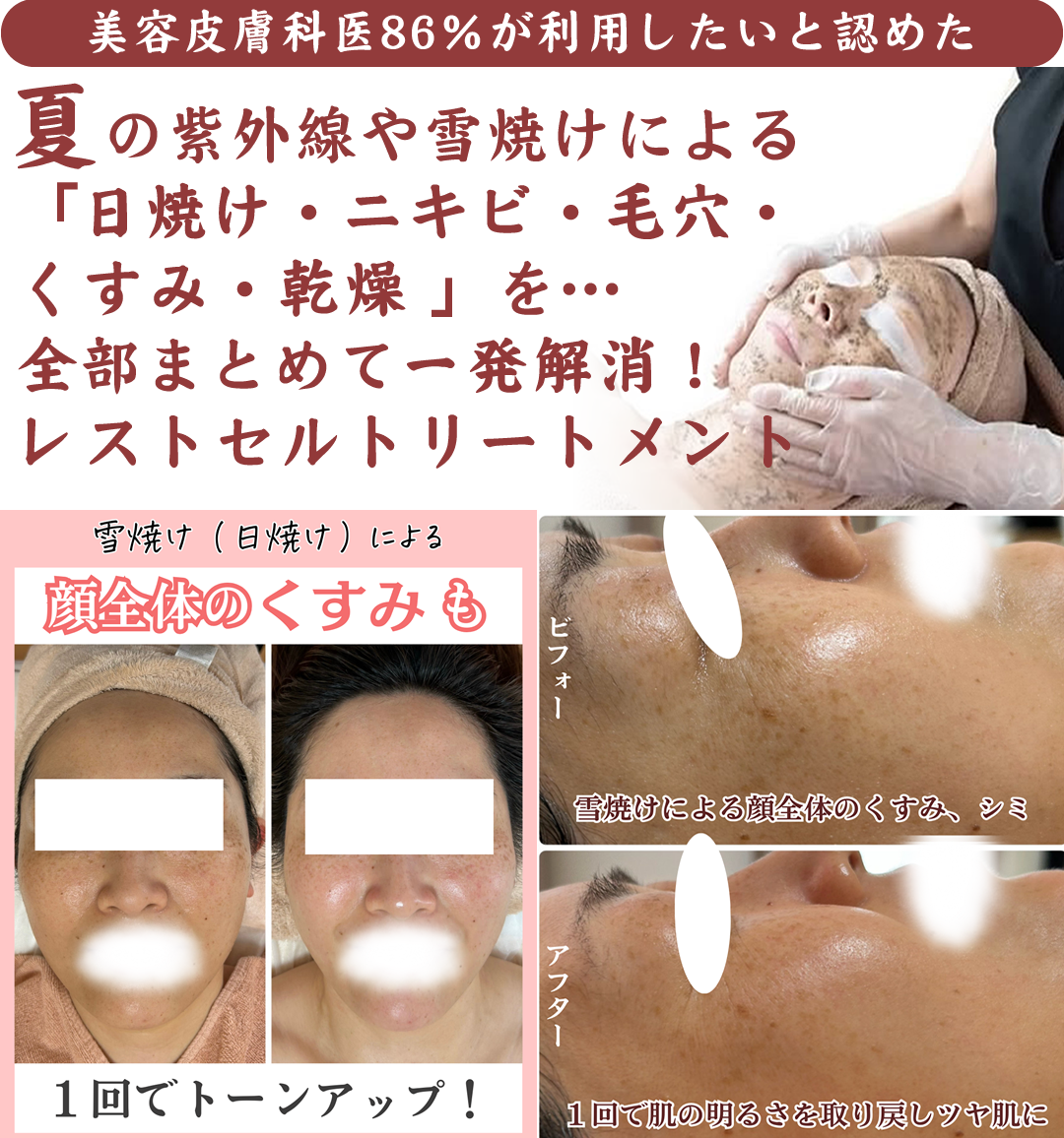 夏の紫外線や雪焼けによる「日焼け・ニキビ・毛穴・くすみ・乾燥 」を…全部まとめて一発解消！レストセルトリートメント
