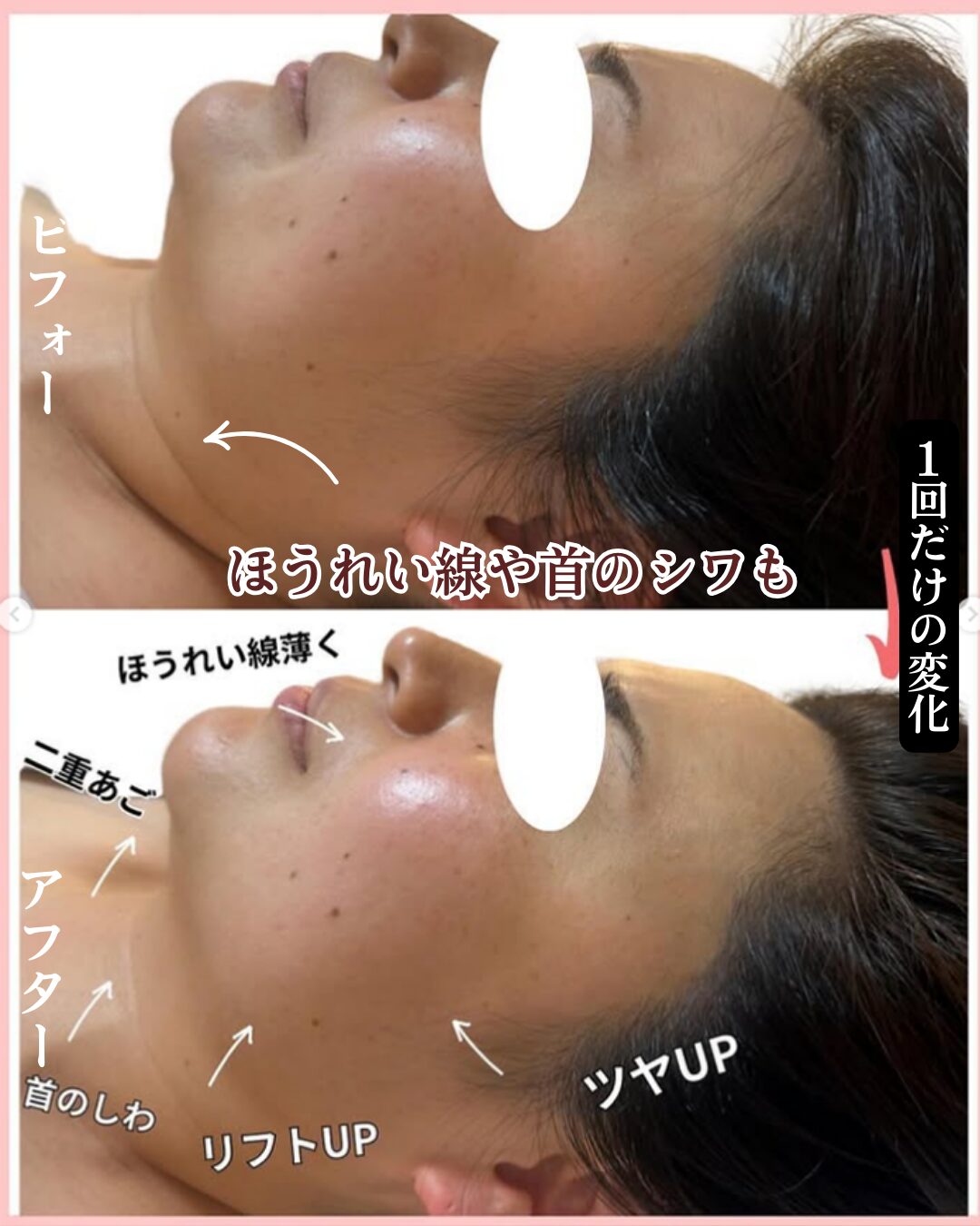 リフトアップのビフォーアフター画像１