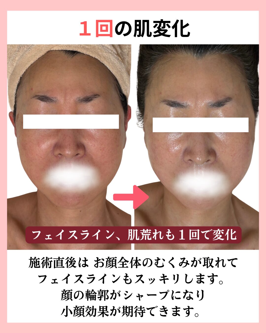 小顔・リフトアップのビフォーアフター画像正面