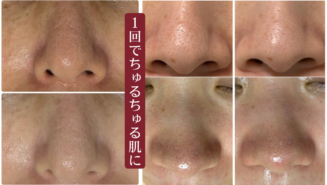 毛穴がキレイになったビフォーアフター画像