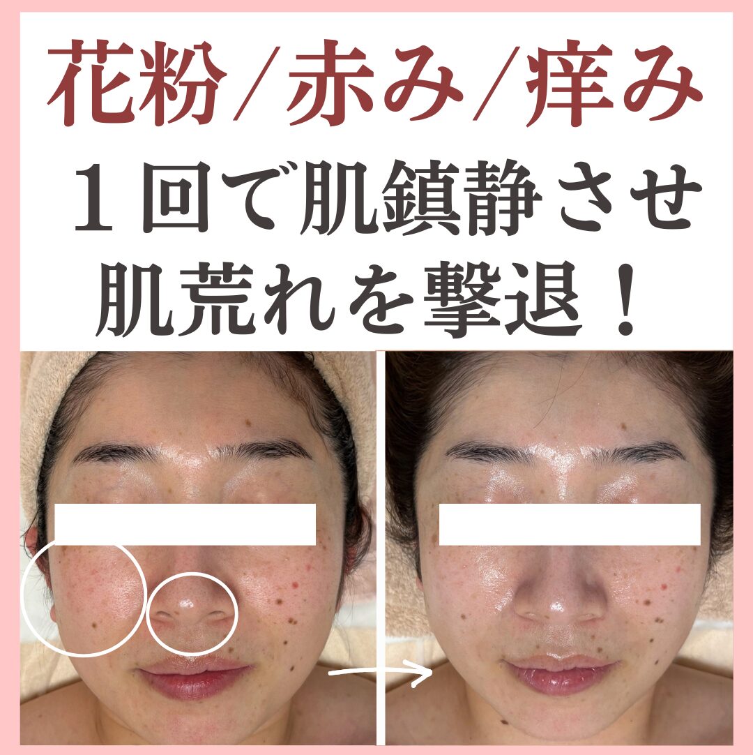 花粉による肌荒れのビフォーアフター画像