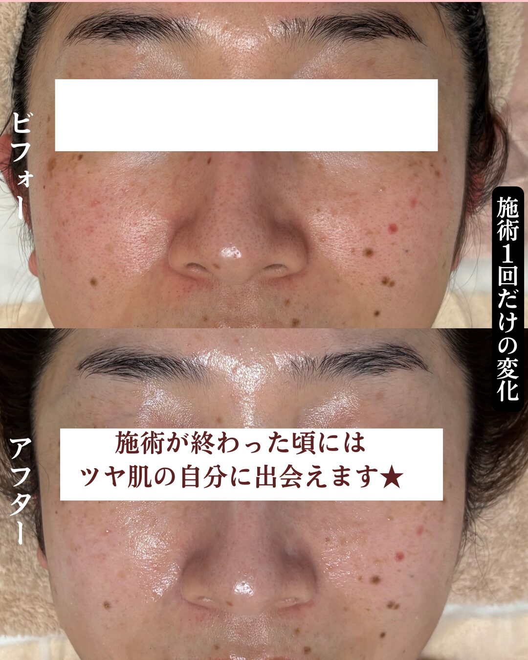 花粉による肌荒れのビフォーアフター画像３枚目