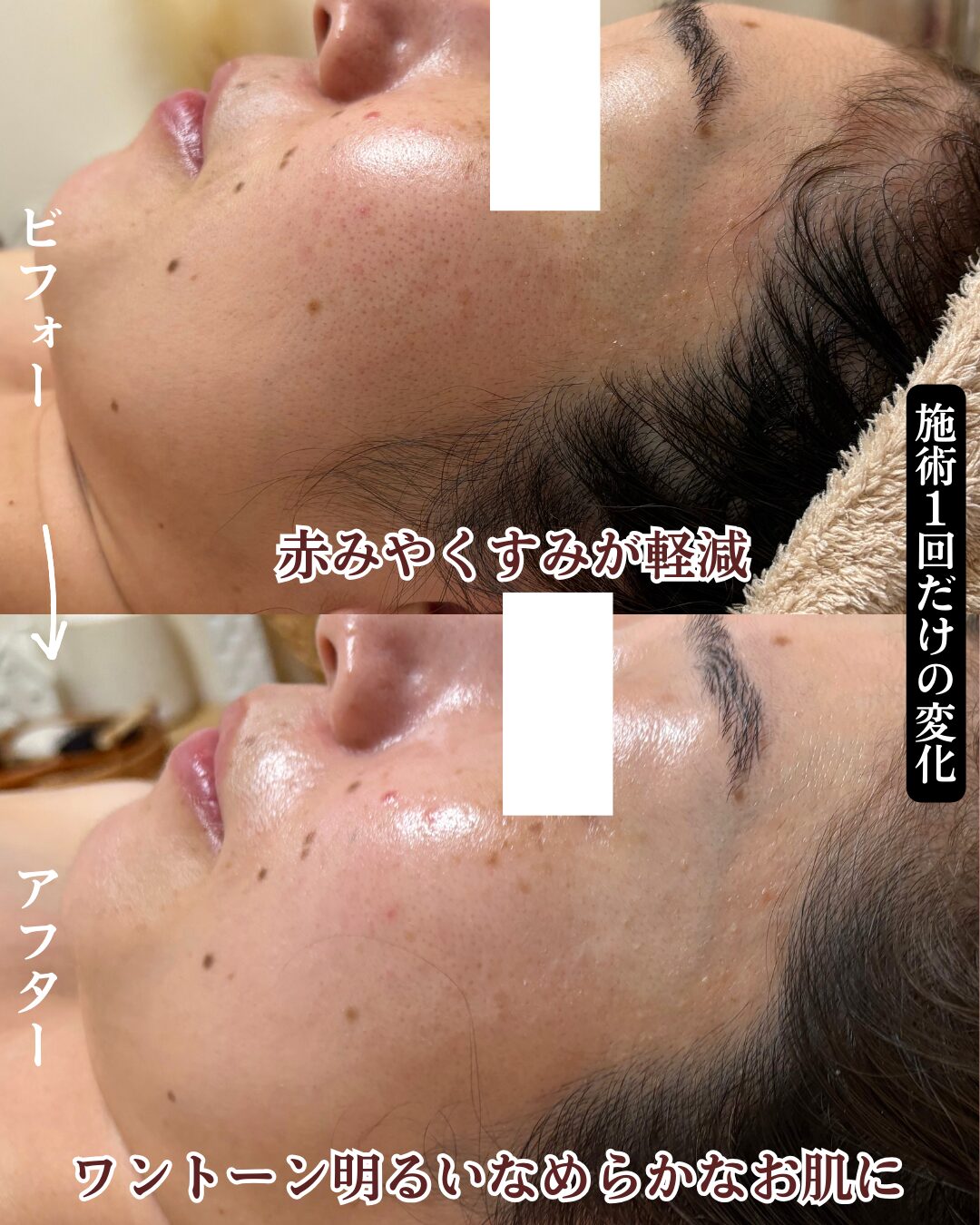 花粉による肌荒れのビフォーアフター画像４枚目