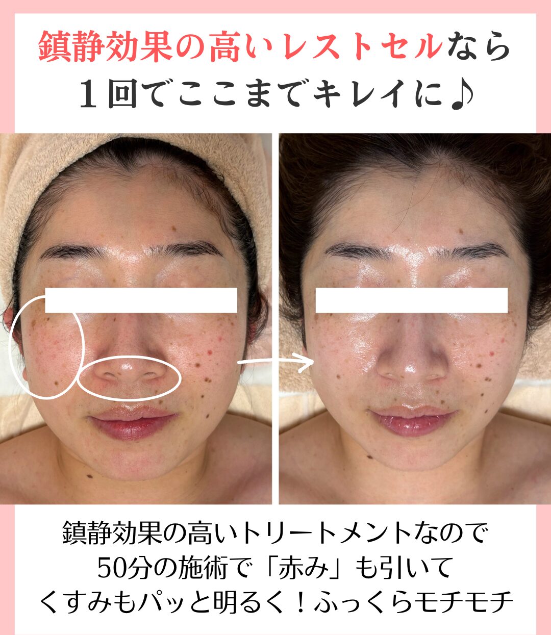 花粉による肌荒れのビフォーアフター画像２枚目