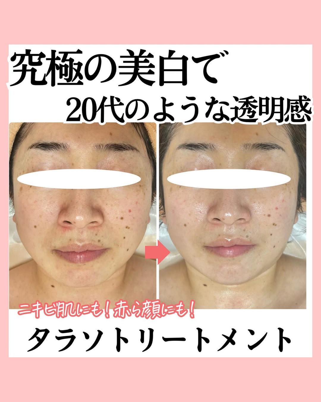 【赤ら顔】ニキビ跡・小鼻の赤みが改善したビフォーアフター画像