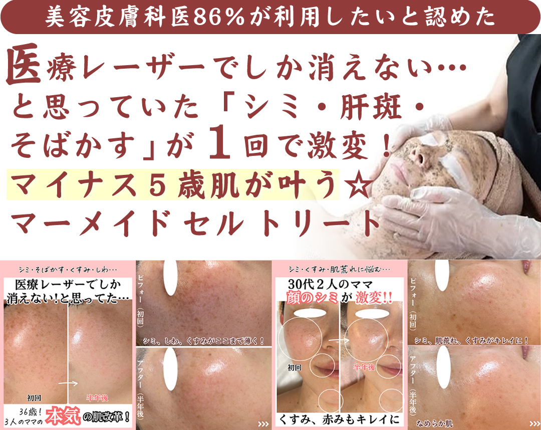 産後に出来たシミ・肝斑・そばかすを、、ヒト×植物幹細胞を使った話題の美肌再生フェイシャル