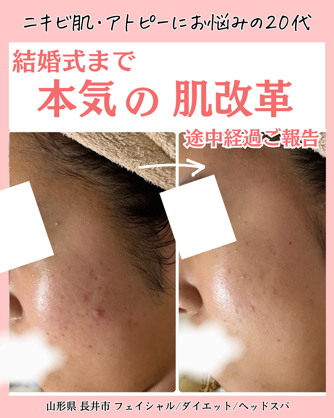 お客様のニキビのビフォーアフター