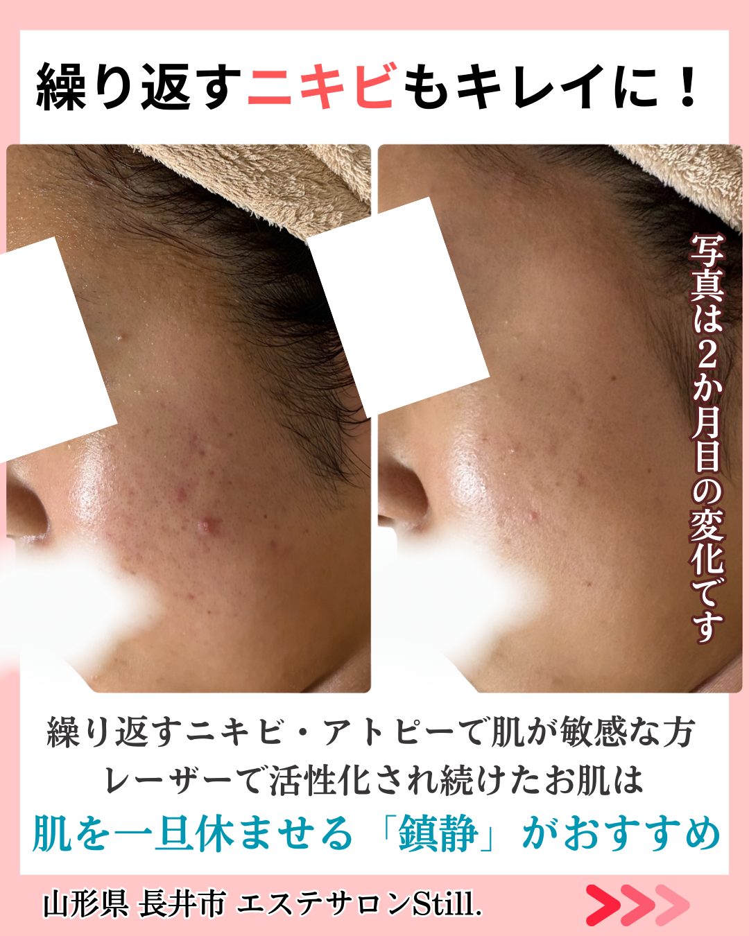 繰り返すニキビがキレイになったビフォーアフター１枚目