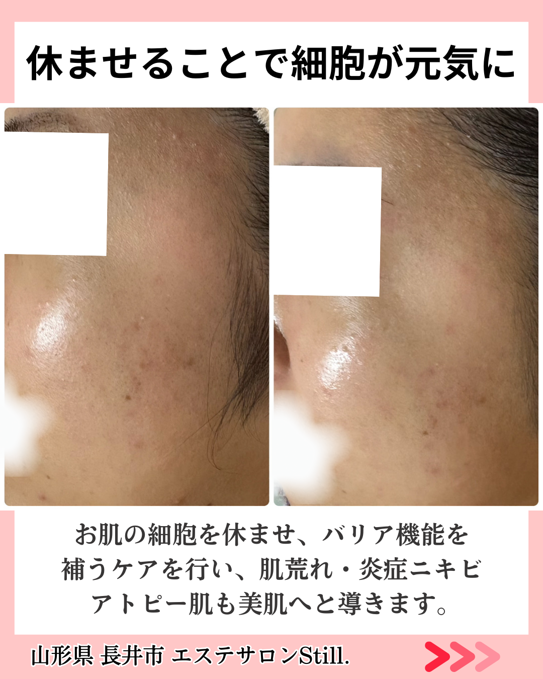 繰り返すニキビがキレイになったビフォーアフター２枚目