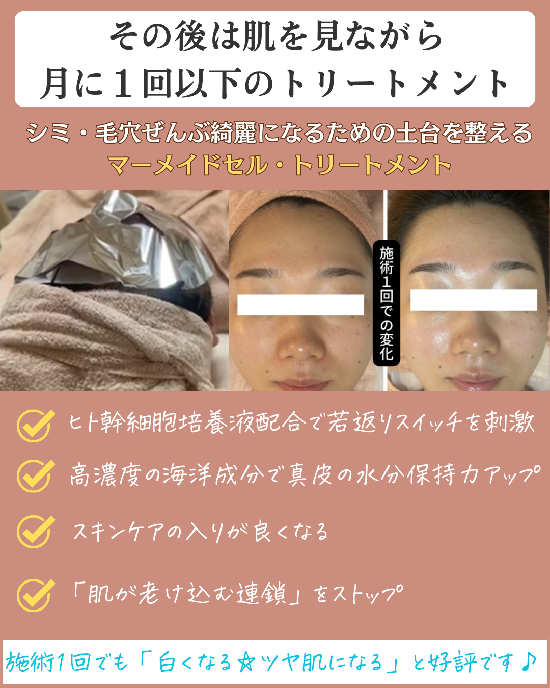 繰り返すニキビがキレイになったビフォーアフター４枚目