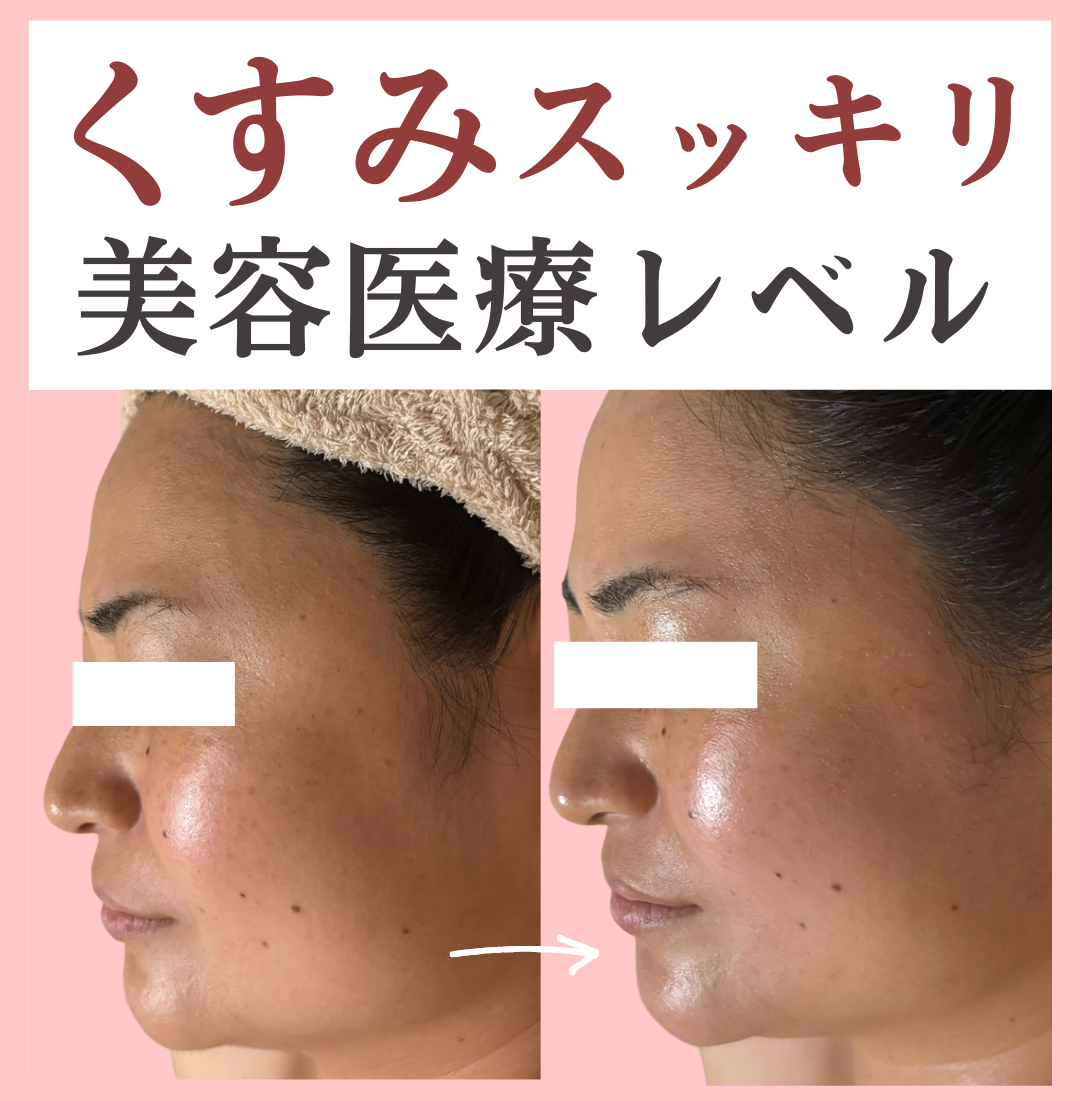くすみが改善したビフォーアフターの画像