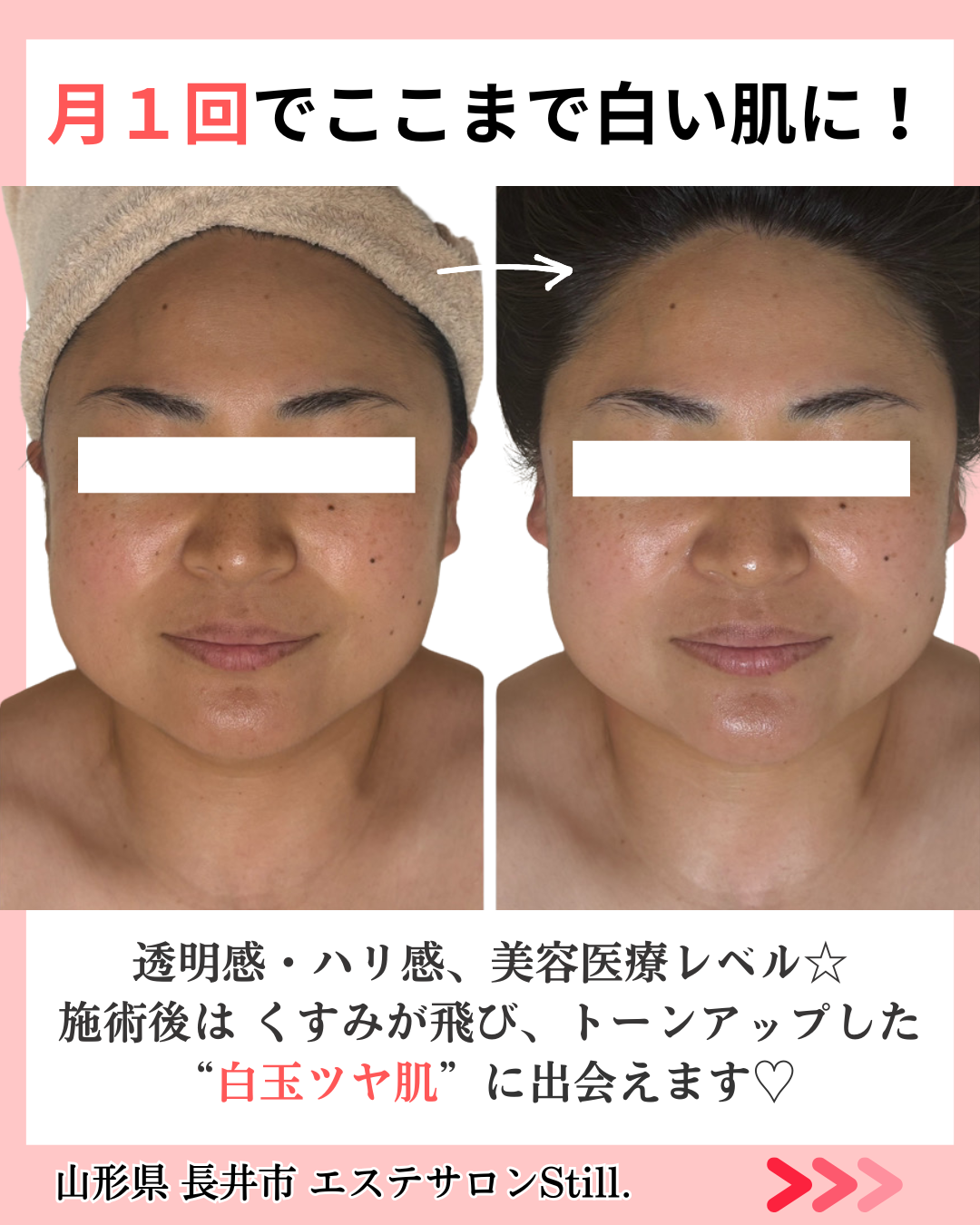 くすみが改善したビフォーアフターの画像（真正面）