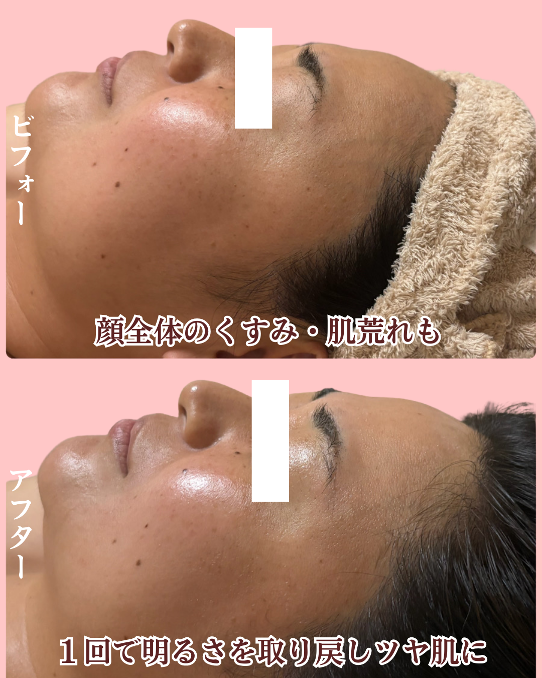 くすみが改善したビフォーアフターの画像（左横顔）