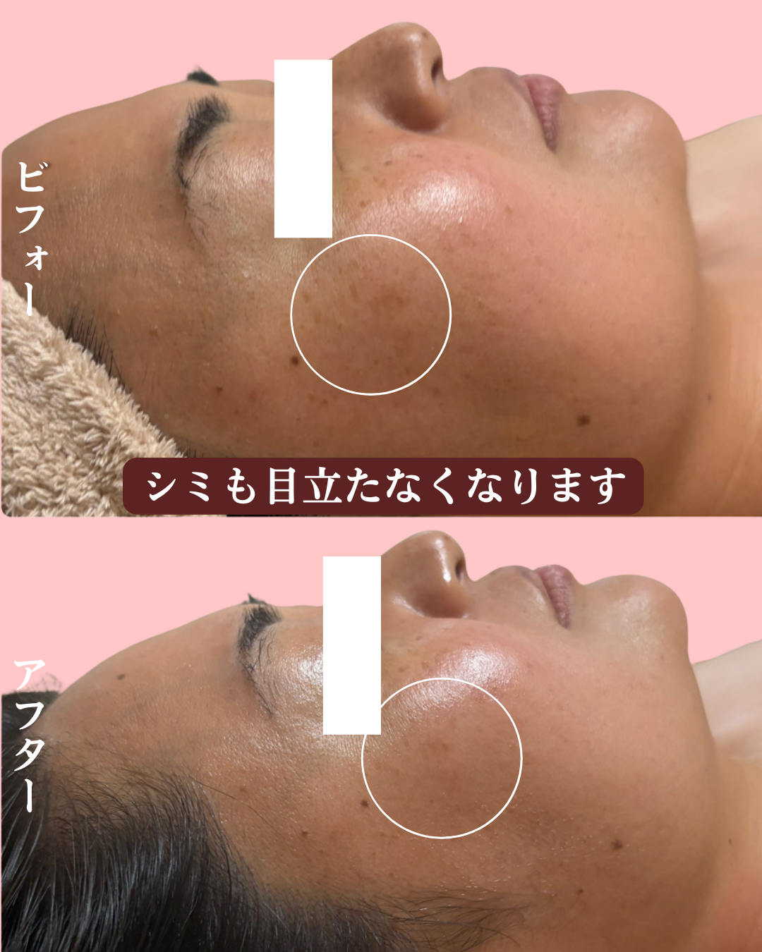 くすみが改善したビフォーアフターの画像（右横顔）