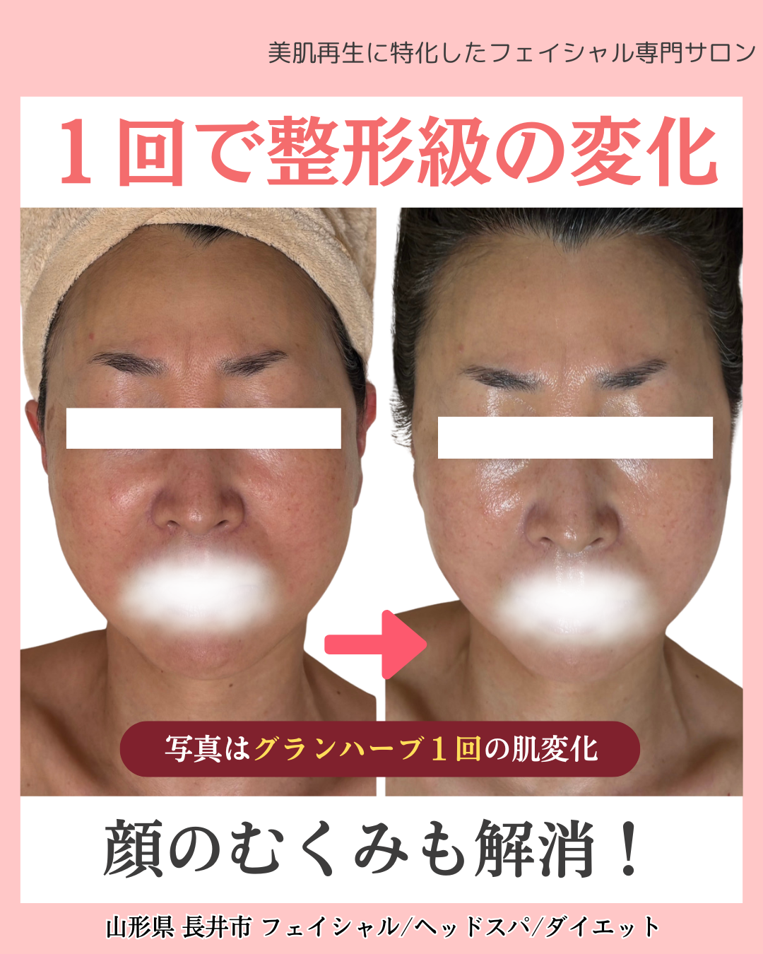 顔のむくみも取れてフェイスラインがスッキリしたビフォーアフターの写真