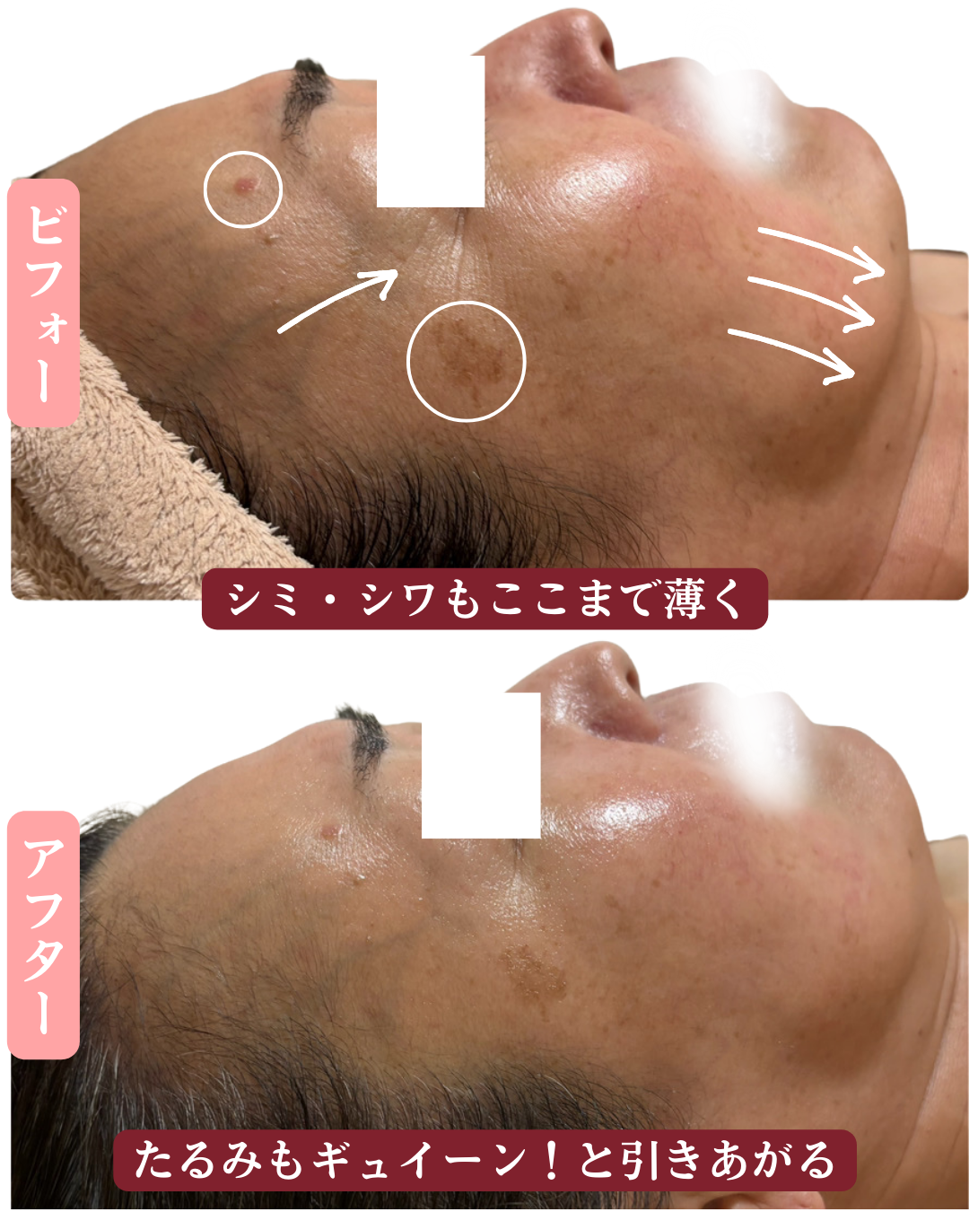 右側から見たビフォーアフターの写真（顔のたるみが引きあがった写真）