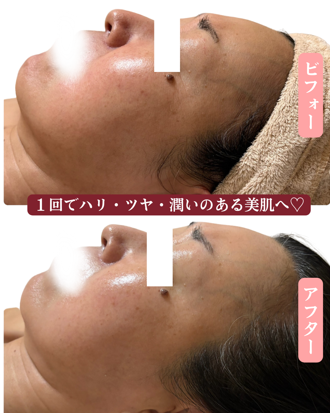 シミ、シワ、ハリ艶の変化の写真（左側から見た写真）