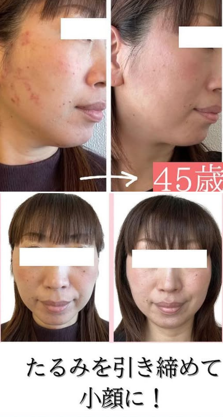 肌荒れに悩む人のビフォーアフター写真