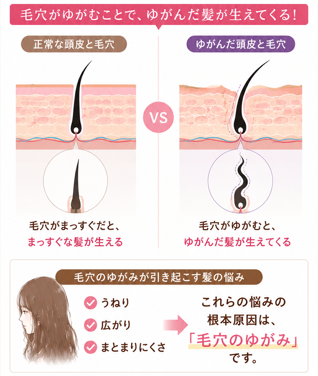 毛穴が変形して、髪の毛がうねる仕組みを解説した画像