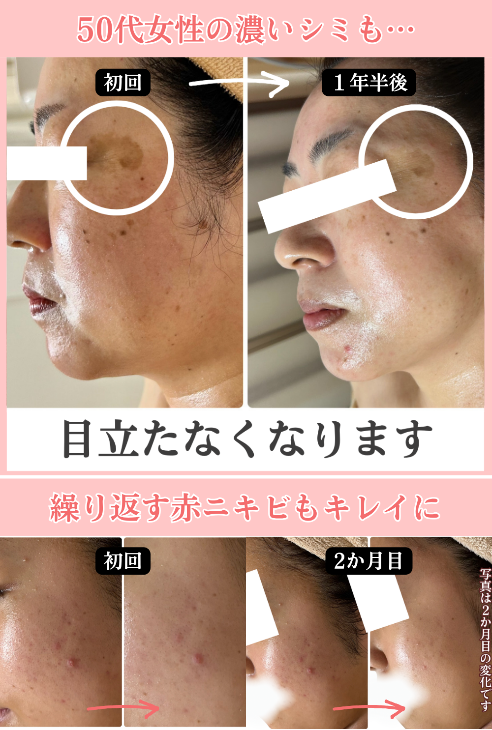 50代女性の濃いシミの変化と、繰り返す赤ニキビの女性のビフォーアフター写真